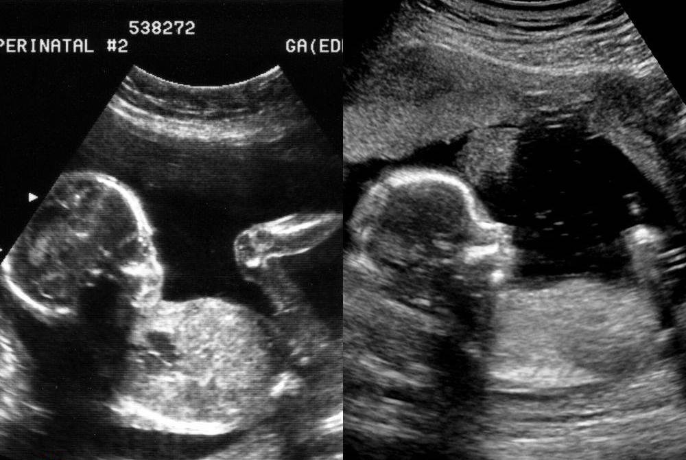 Welches von beiden wurde bei einer Vergewaltigung gezeugt?