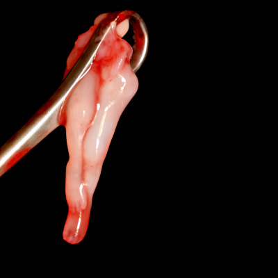 Abgetriebenes Kind, 10 Wochen