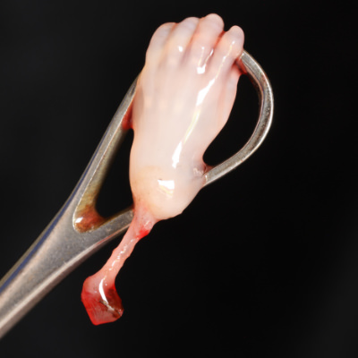 Abgetriebenes Kind, 13 Wochen