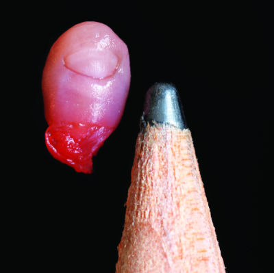 Abgetriebenes Kind, 14 Wochen