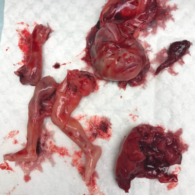 Abgetriebenes Kind, 15 Wochen