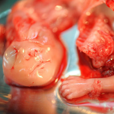 Abgetriebenes Kind, 15 Wochen