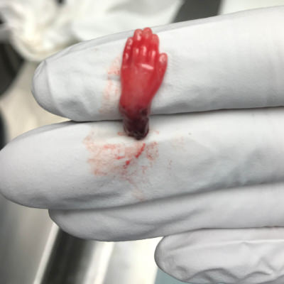 Abgetriebenes Kind, 15 Wochen