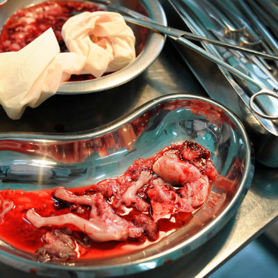 Abgetriebenes Kind, 15 Wochen