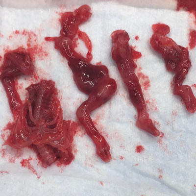 Abgetriebenes Kind, 15 Wochen