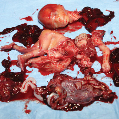 Abgetriebenes Kind, 20 Wochen