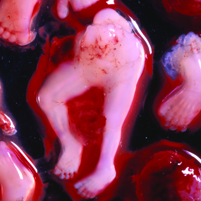 Abgetriebenes Kind, 6-10 Wochen