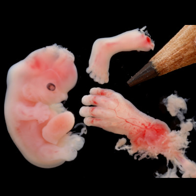 Abgetriebenes Kind, 6 & 13 Wochen